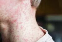 Ruam merah pada kulit menjadi salah satu gejala utama penyakit campak yang sangat mudah menular.