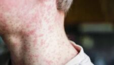 Ruam merah pada kulit menjadi salah satu gejala utama penyakit campak yang sangat mudah menular.