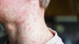 Ruam merah pada kulit menjadi salah satu gejala utama penyakit campak yang sangat mudah menular.